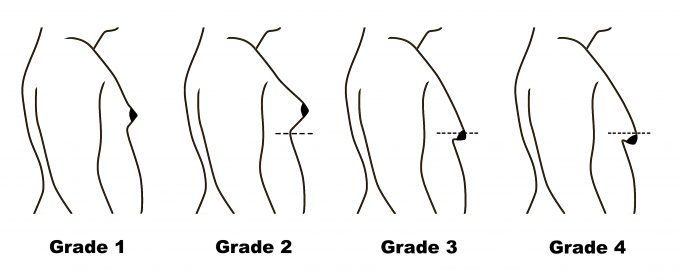 gyno_stages_bodybuilding